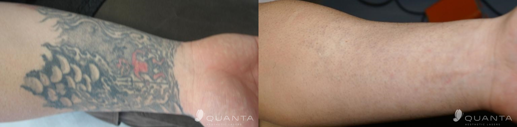 Everything You Need to Know About Laser Tattoo Removal: N. Hasan, MD:  Medical Spa